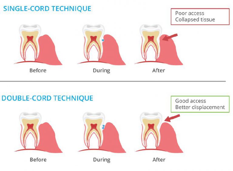 Gingival Retraction Cord Techniques Arklign